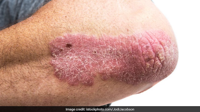This home remedy can help in reducing symptoms of psoriasis and eczema