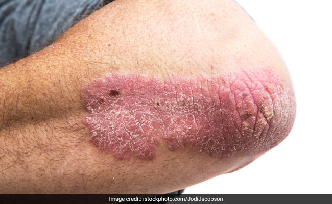 This home remedy can help in reducing symptoms of psoriasis and eczema