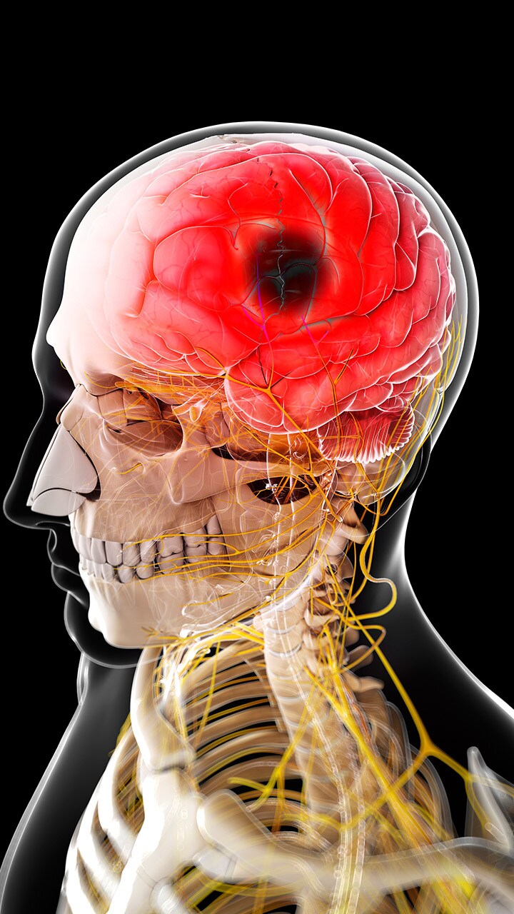 stroke