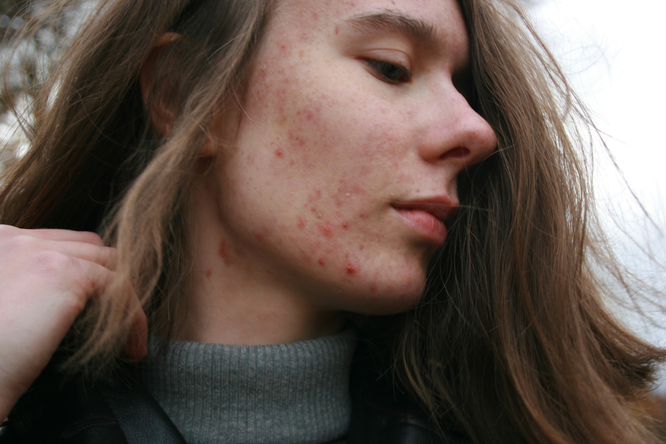 Skin care