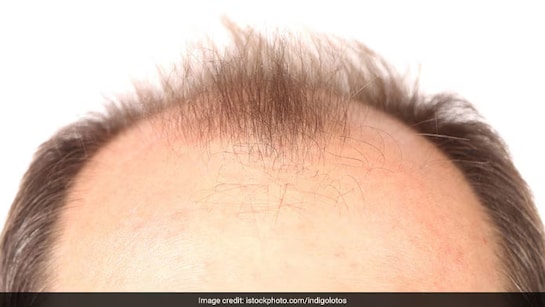 गंजी खोपड़ी पर भी उग सकते हैं नए बाल, बस शैंपू के साथ इस पानी को मिलाकर धोलें बाल, हर कोई पूछेगा राज