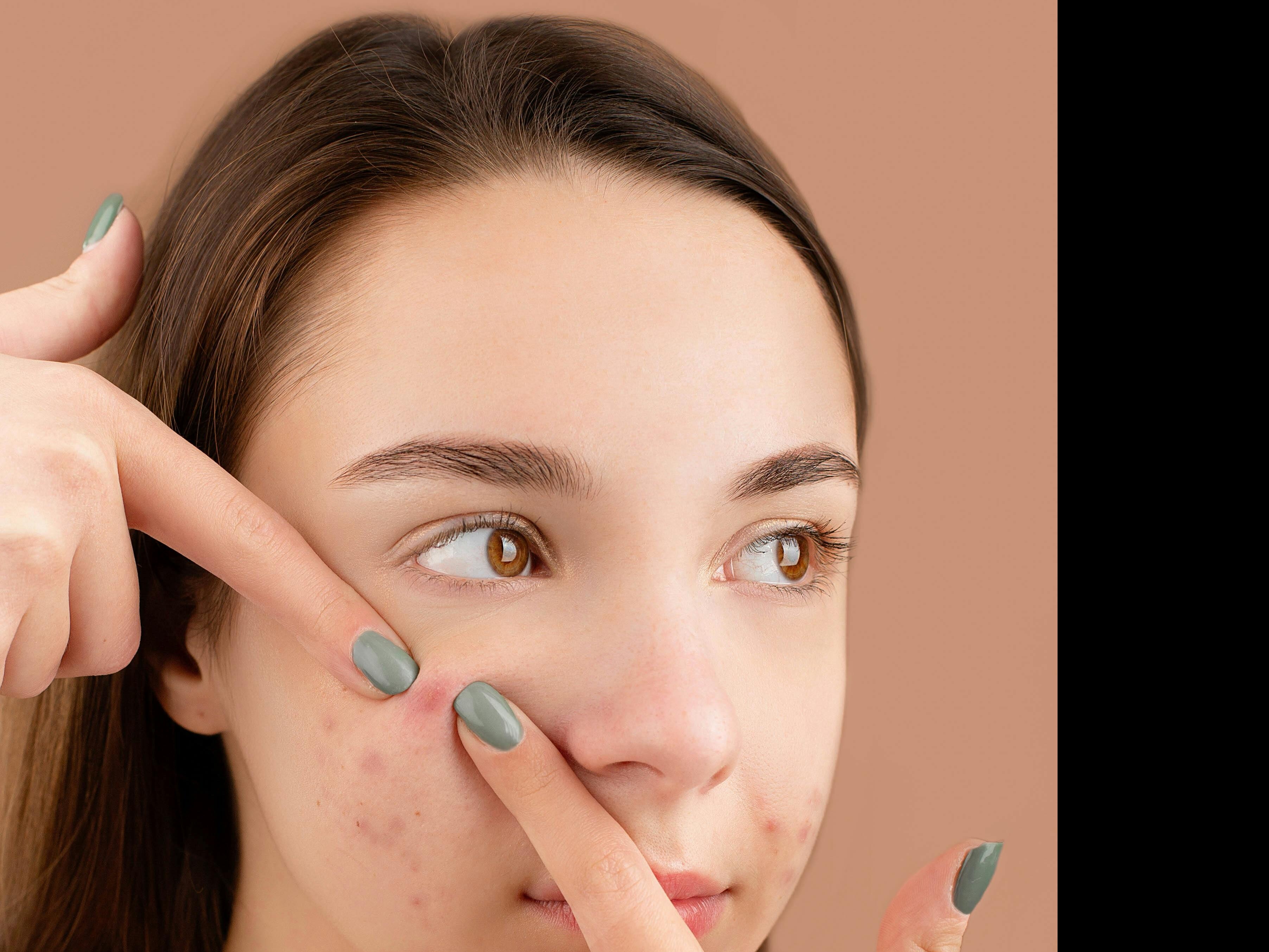 9 things to try when acne won't clear - American Academy of Dermatology