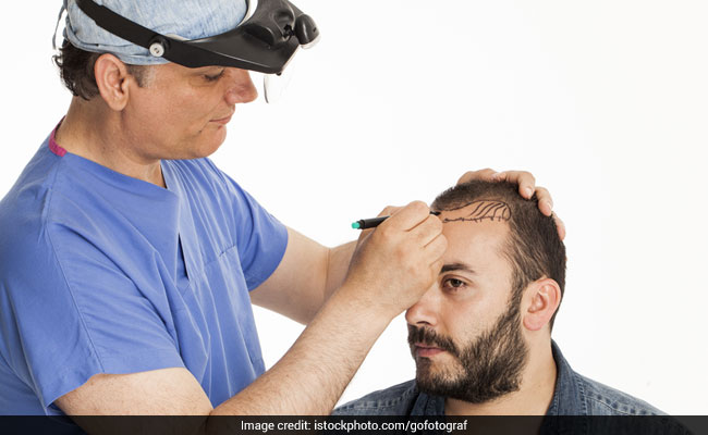Hair Transplants Must Be Performed Only By Qualified Persons: Medical Body