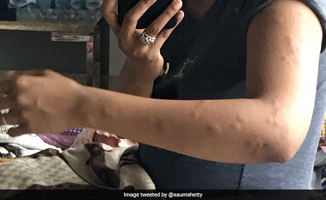 Passenger Tweets Pic Of Bedbug Bites, Took Air India US To Mumbai Flight