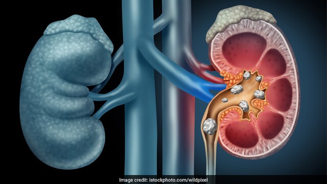 Kidney stones can be removed at home by drinking lots of water