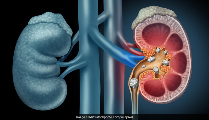 Kidney stones can be removed at home by drinking lots of water