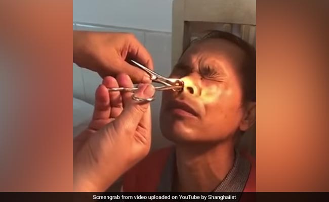 Doctor Pulls Out Blood-Sucking Leech From Man's Nose In Horrifying Video