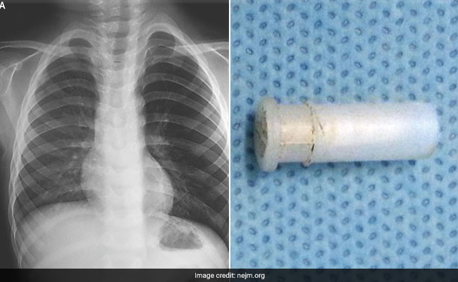 AIIMS Cures 4-Year-Old Of 'Whistling Cough' - He Had Whistle Stuck In Throat