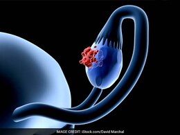 गुरुग्राम के डॉक्टरों ने 13 साल की लड़की की Ovary से निकाला 8.5 किलो का ट्यूमर गुरुग्राम के डॉक्टरों ने 13 साल की लड़की की Ovary से निकाला 8.5 किलो का ट्यूमर