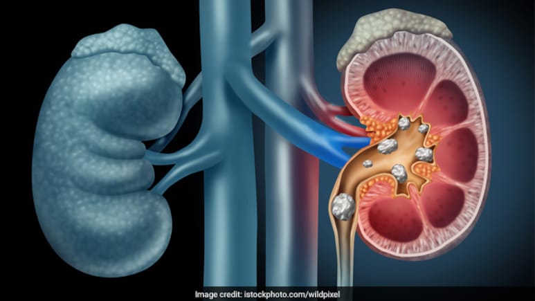 किसी विटामिन की कमी से किडनी में पथरी बन सकती है? जानें इसके लिए क्या खाएं-पिएं