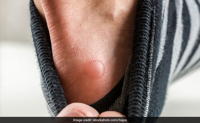 Foot blisters are little blemishes or boils on the foot caused by heat