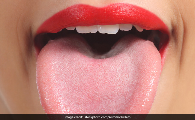 'Black Hairy Tongue' Is An Actual Medical Condition, And It Looks As Weird As It Sounds