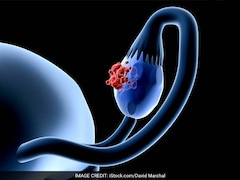 ओवेरियन कैंसर के शुरुआती लक्षण कैसे पहचाने, डॉक्टर से जानें कौन से टेस्ट हैं जरूरी