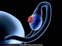 ओवेरियन कैंसर के शुरुआती लक्षण कैसे पहचाने, डॉक्टर से जानें कौन से टेस्ट हैं जरूरी