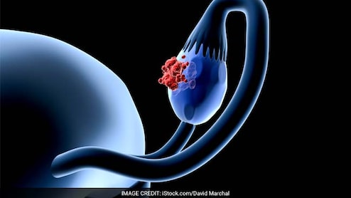 ओवेरियन कैंसर के शुरुआती लक्षण कैसे पहचाने, डॉक्टर से जानें कौन से टेस्ट हैं जरूरी