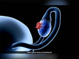 World Ovarian Cancer Day 2025: हर साल 8 मई को मनाया जाता है विश्व ओवेरियन कैंसर दिवस, जाने बचाव के उपाय