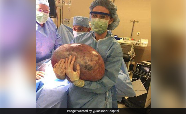 She Kept Gaining Weight, Didn't Know Why. It Was A 50-Pound Ovarian Cyst