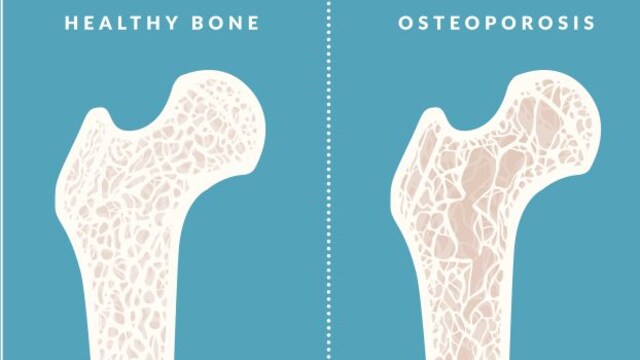 Osteoporosis prevention: Add more calcium to your diet for healthy bones