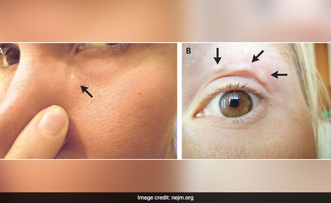 Blemishes On Her Face Kept Moving. It Was A Parasitic Worm Under Her Skin