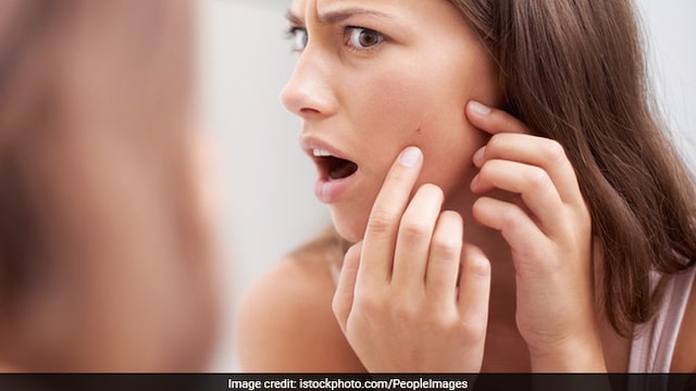 Acne tips: Avoid fried food to prevent sudden acne breakout