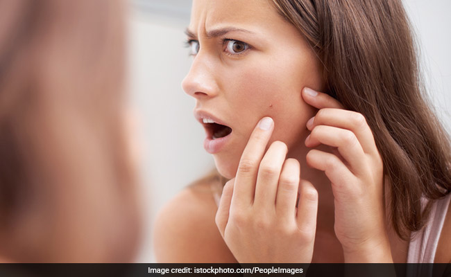 Acne tips: Avoid fried food to prevent sudden acne breakout