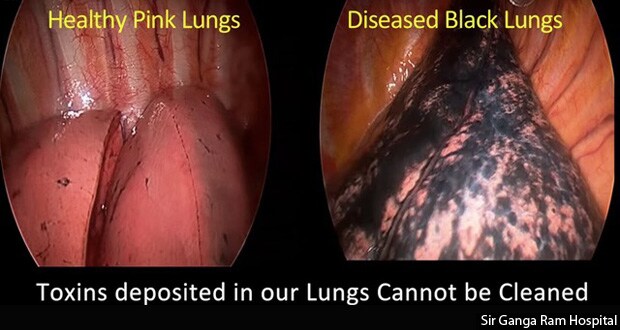A comparison of images of healthy and diseased lungs. Of 150 lung cancer patients surveyed in Sir Ganga Ram Hospital, New Delhi, 74 were non-smokers.