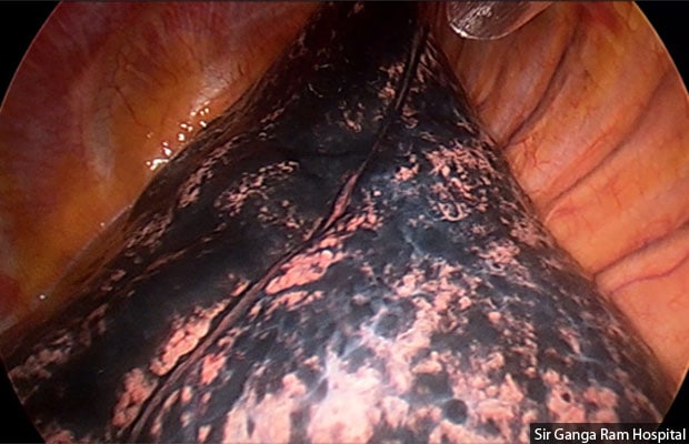 The image of a black lung in a non-smoker and lung cancer patient at Sir Ganga Ram Hospital, Delhi, shows how even young lungs have the appearance of a smoker's.