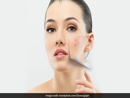 Mix Petroleum Jelly With This To Instantly Get Rid Of Pimples: What Dermatologists Recommend Mix Petroleum Jelly With This To Instantly Get Rid Of Pimples: What Dermatologists Recommend