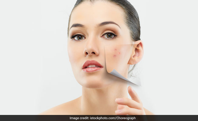 Acne home remedis: Wash face with neem water to get rid of acne naturally