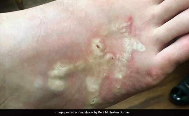 Hookworms Burrowed Into Teen's Skin On Trip. You Can't Unsee These Images