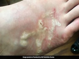 Hookworms Burrowed Into Teen's Skin On Trip. You Can't Unsee These Images Hookworms Burrowed Into Teen's Skin On Trip. You Can't Unsee These Images