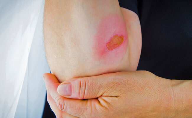 Good News For Burn Victims: Artificial Skin Could Help Them Feel