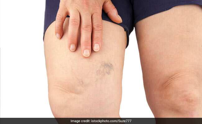 Swelling Of Feet Home Remedies: पैरों में सूजन और दर्द से हैं परेशान? यहां हैं 6 कारगर घरेलू उपाय, जानें कैसे करें इस्तेमाल!