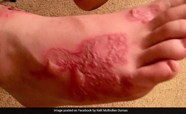 Hookworms Burrowed Into a Teenager's Skin After Visiting a Florida Beach