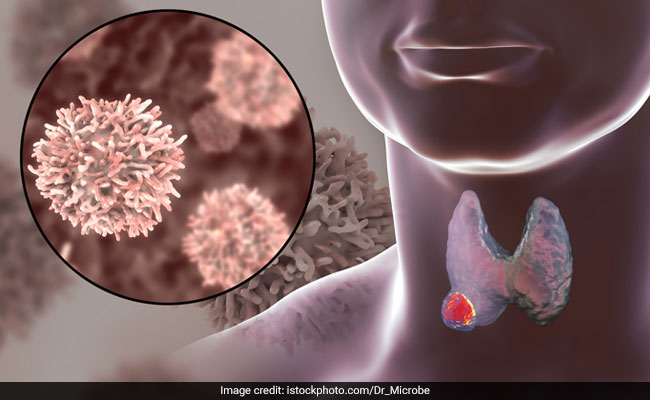 Thyroid Cancer: Causes, Symptoms And Treatments For Thyroid Cancer