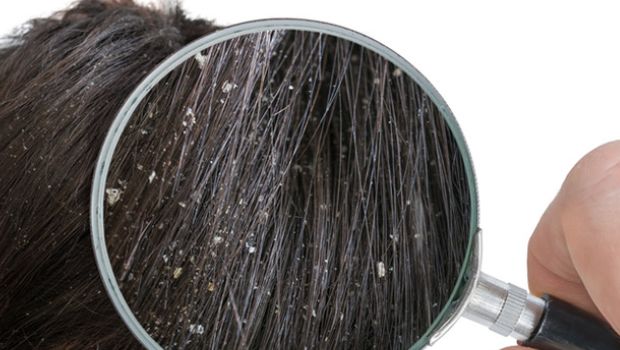 Ayurveda For Dandruff: 5 Home Remedies To Beat Dandruff Naturally