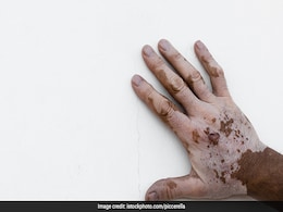 Vitiligo: 10 Expert-Recommended Home Remedies To Your Rescue Vitiligo: 10 Expert-Recommended Home Remedies To Your Rescue