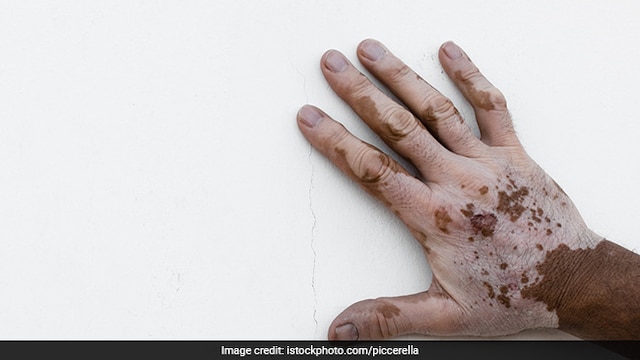 Vitiligo flare ups can be reduced by drinking sufficient water every day