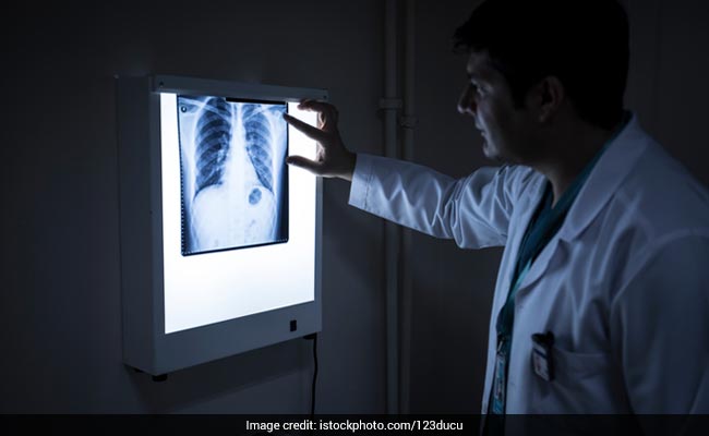 Kolkata Boy Had A Persistent Cough. Doctor Found A Pen Cap In Lung